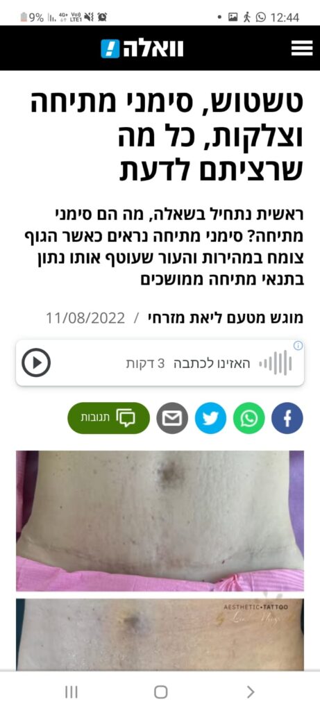 וואלה - כתבה על טשטוש צלקות וסימני מתיחה